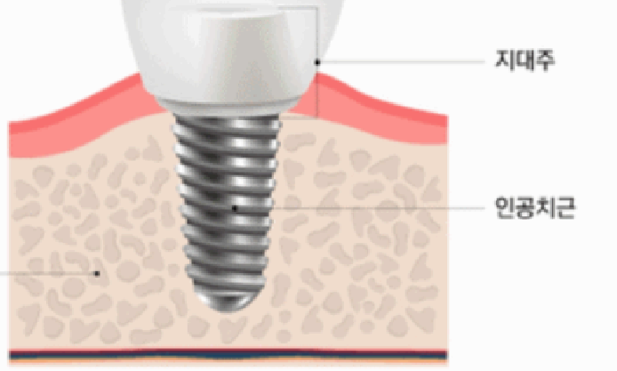 임플란트 시술 과정 사진