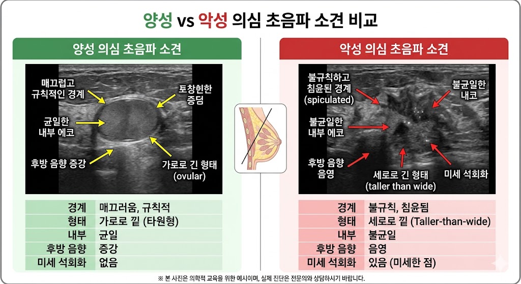 양성 vs 악성 초음파 비교