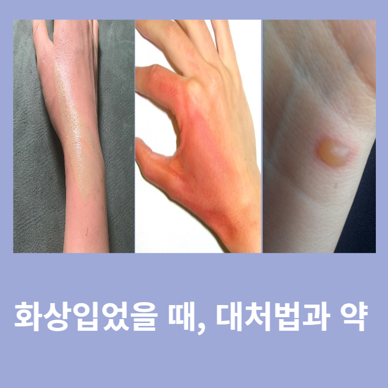 화상