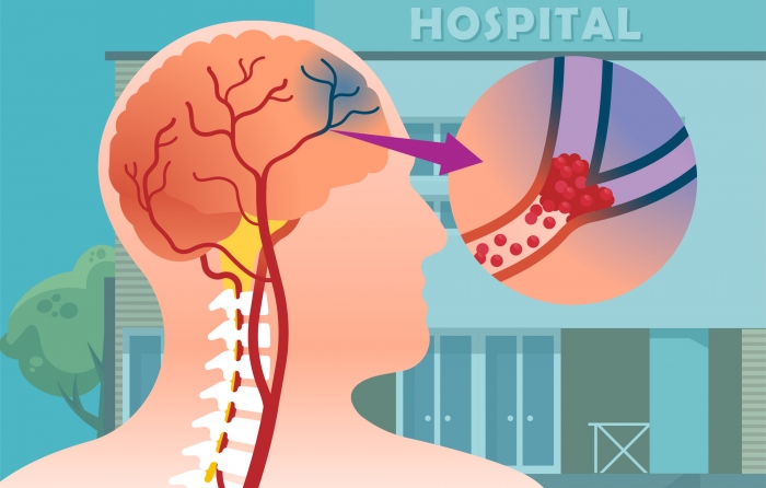 뇌졸중 전조 증상