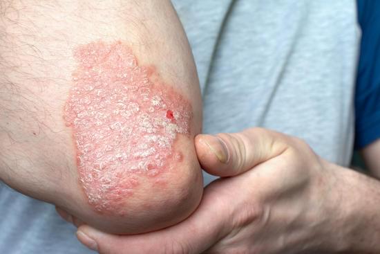 건선(Psoriasis): 원인, 증상, 치료 방법 총정리