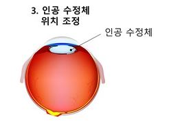 황반변성 치료법