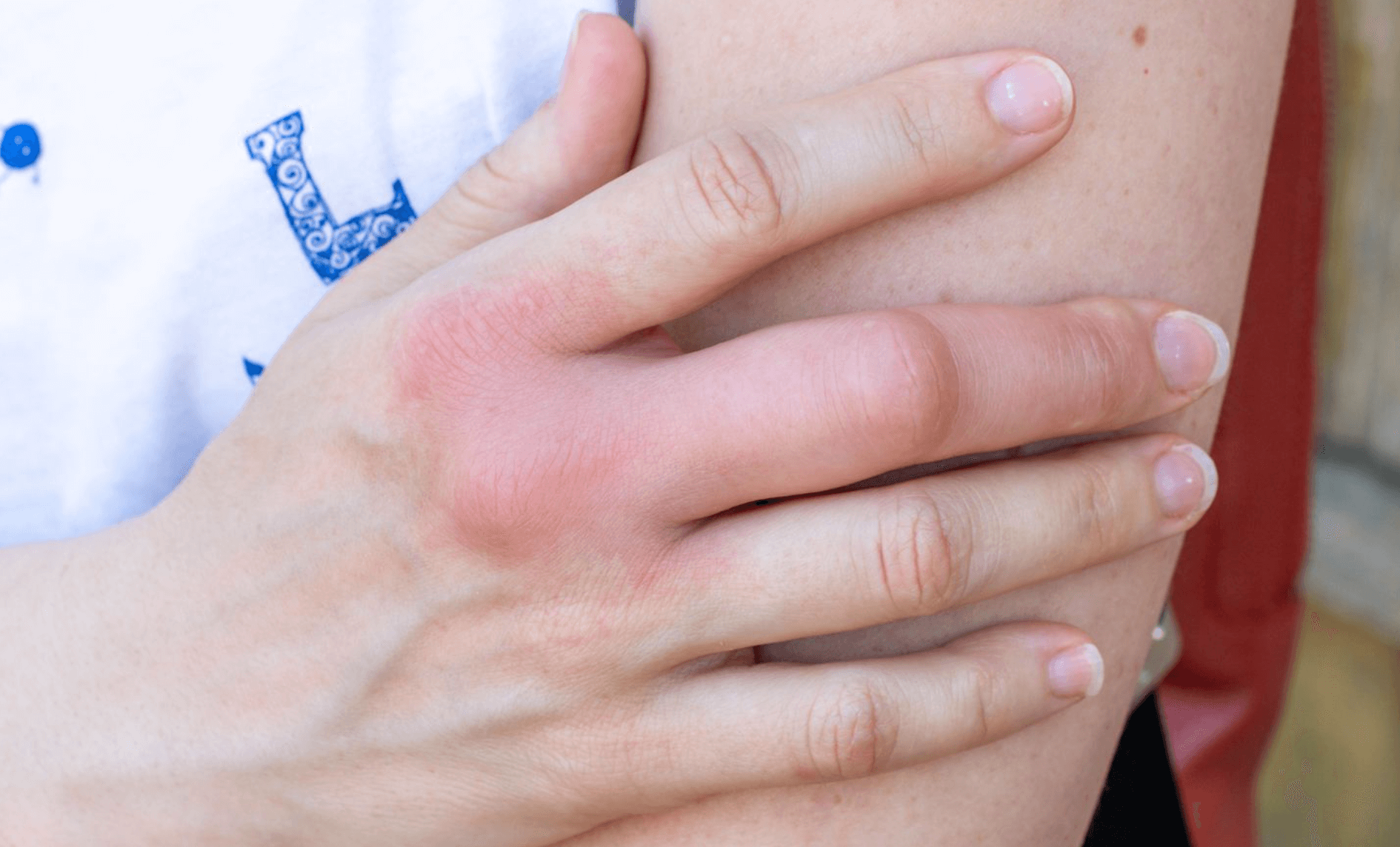 손가락 붓기 줄이는법