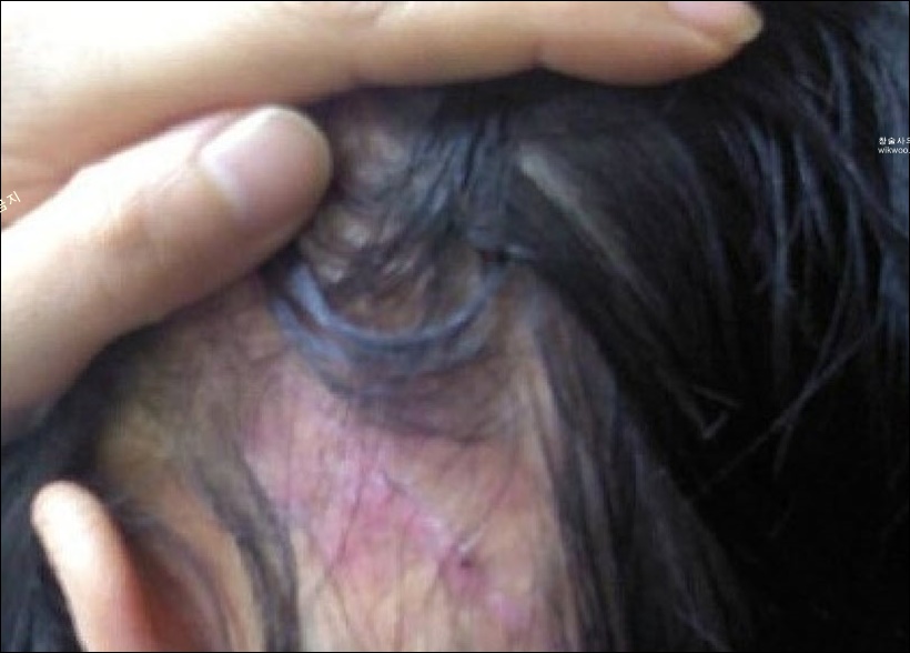 모발이식 부작용 흉터