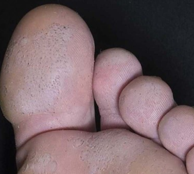 소와각질융해증(pitted keratolysis)