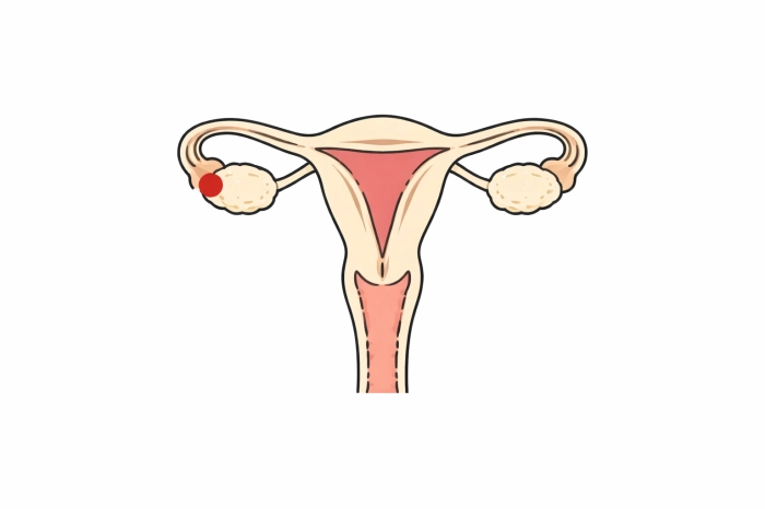 암환자 산정특례 제도