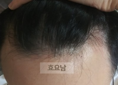M자 모발이식 수술-전