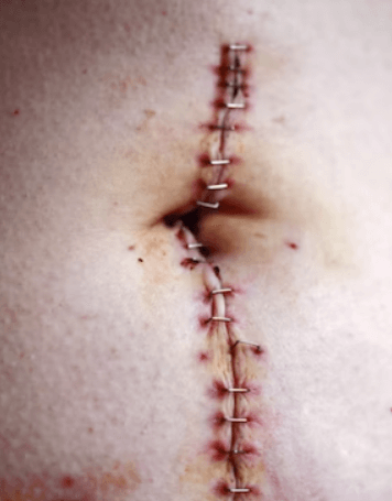 봉와직염 증상 - 상처