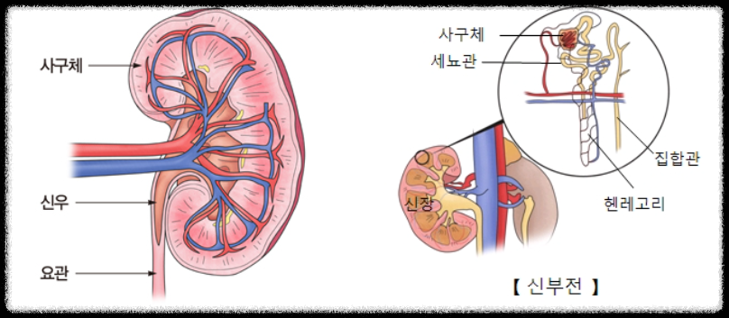 만성신부전증