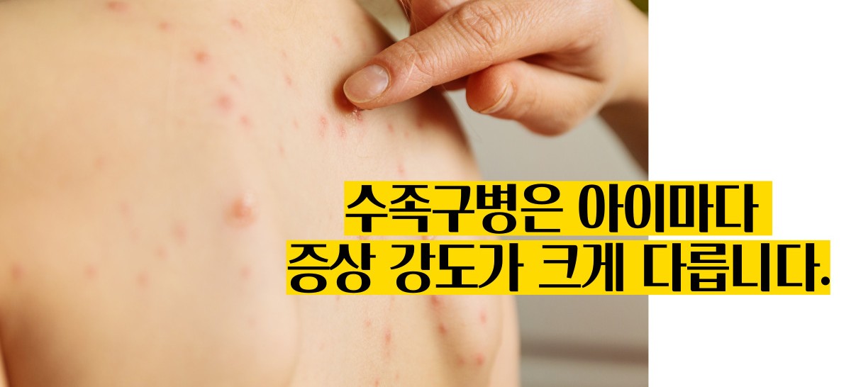 수족구 증상