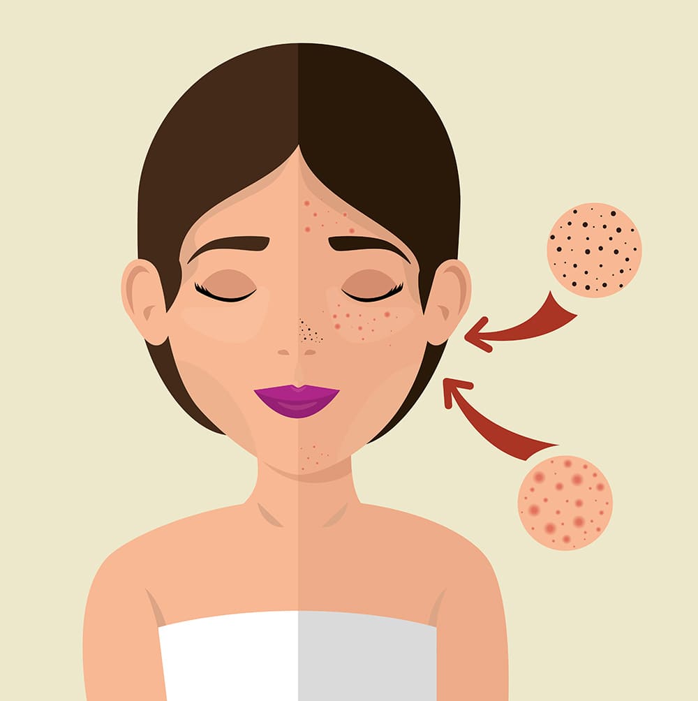 비립종-레이저-시술의-효과와-부작용