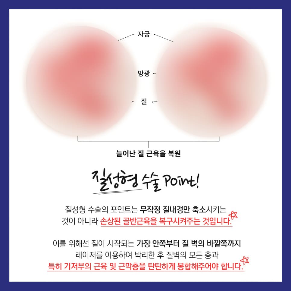 질타이트닝 질이완증 질성형 포인트