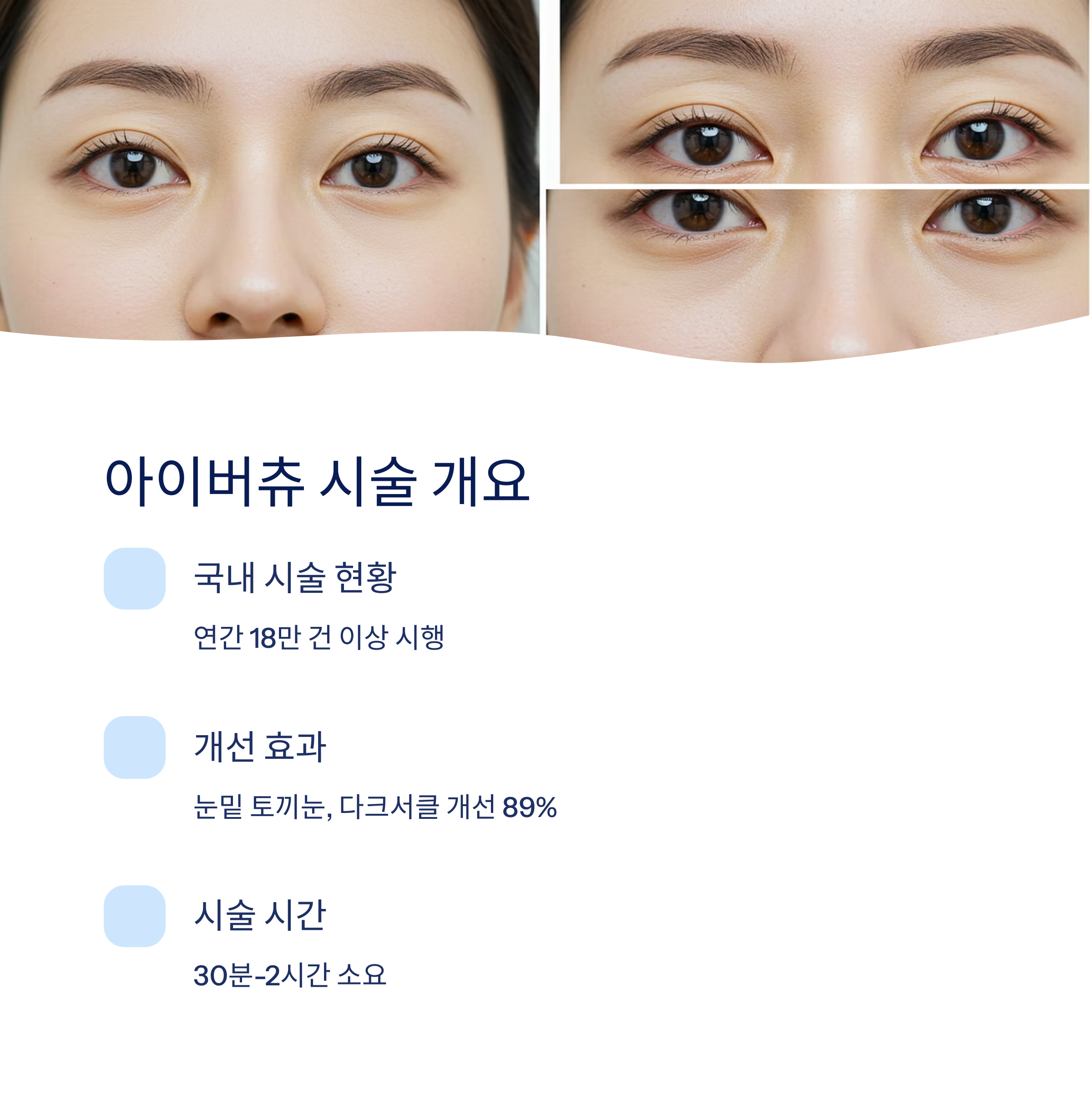 아이버츄 시술 개요